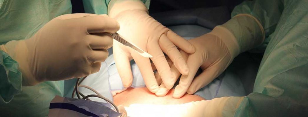 nașterea după operația de vedere)