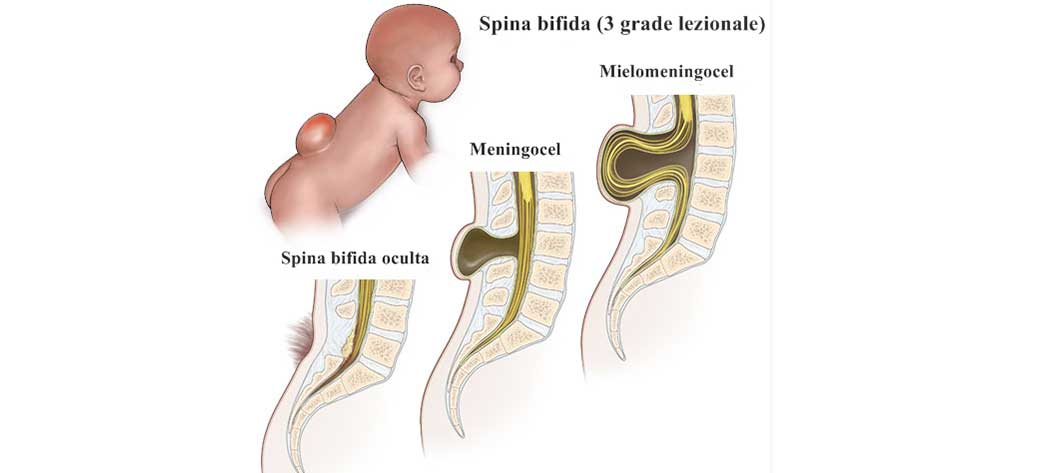 splina bifida acid folic