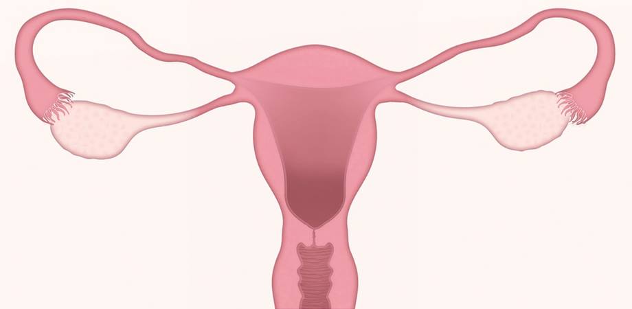 pierdere în greutate polipi uterine