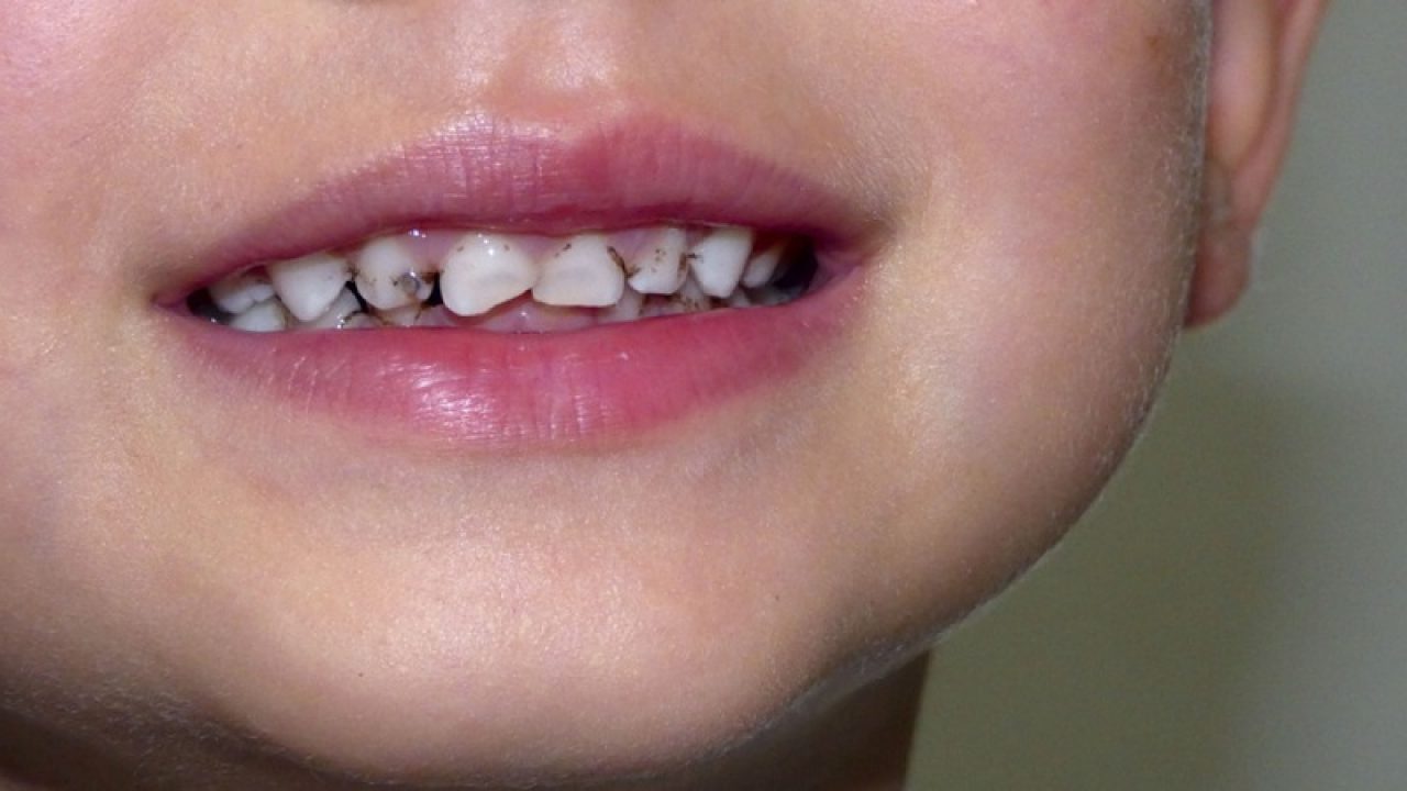 prostatita dinților cariați