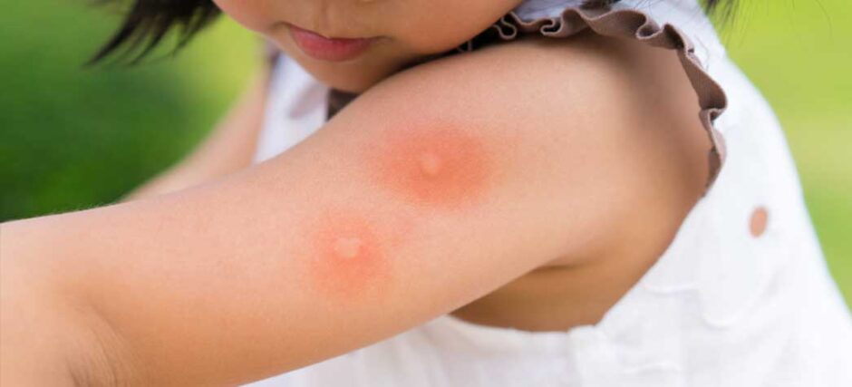 5 solutii pentru calmarea pielii dupa intepaturile de insecte